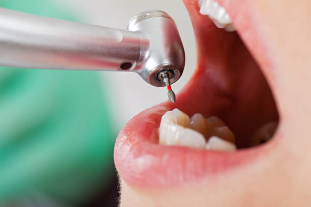 Best Lost Filling or Crown Replacement in San Carlos Park, FL